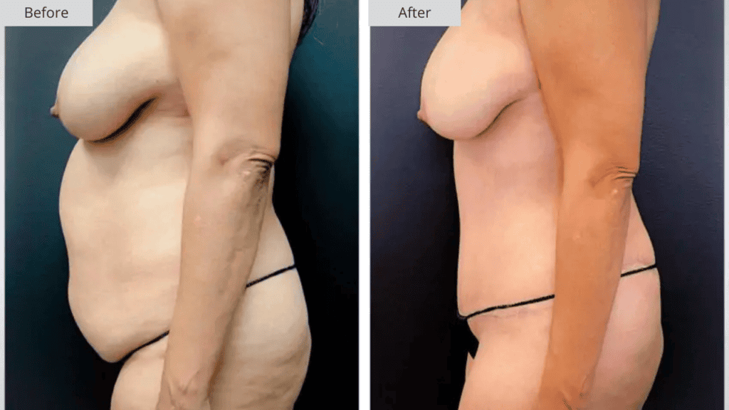 Abdominoplastia Paciente 2