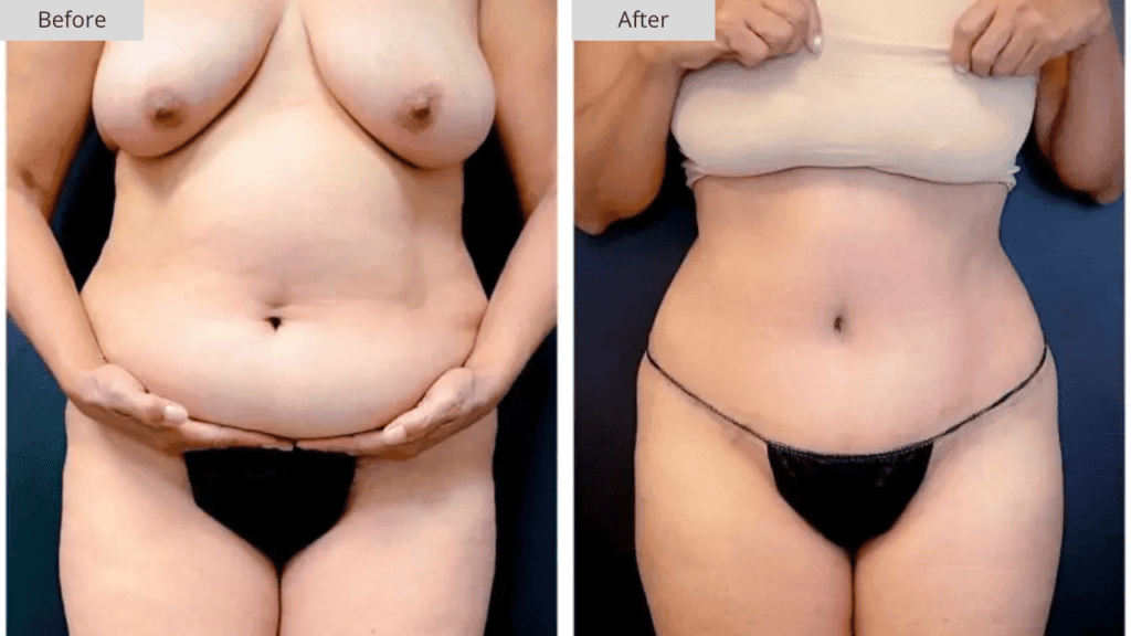 Abdominoplastia Paciente 3