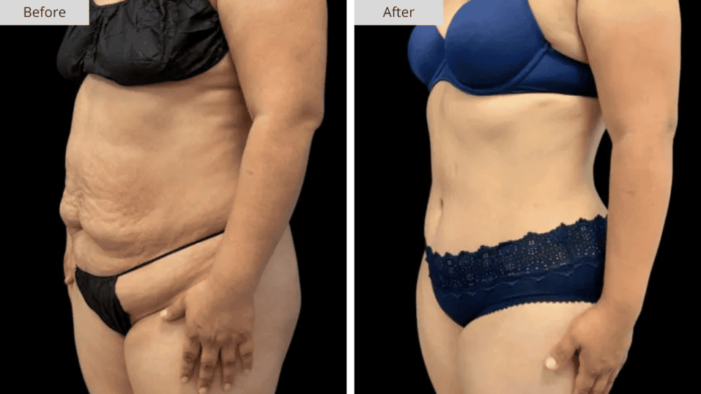Abdominoplastia Paciente 5