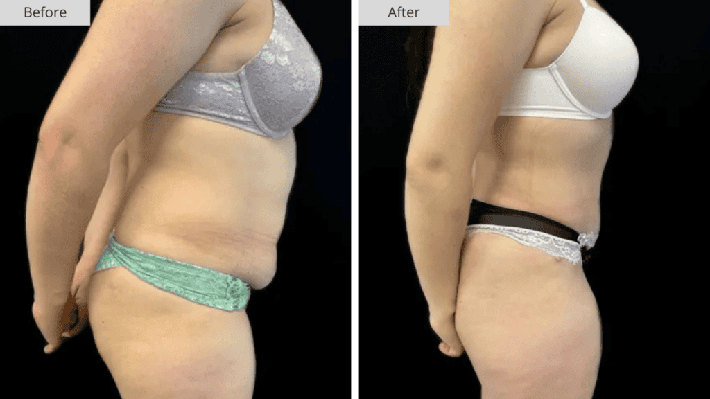 Abdominoplastia Paciente 6