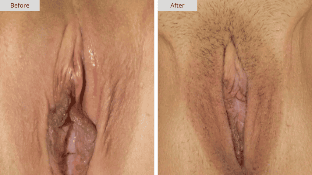 Labioplastia Paciente 3