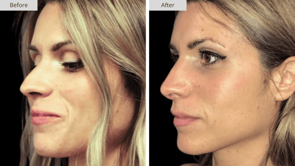 Rinoplastia Paciente 1