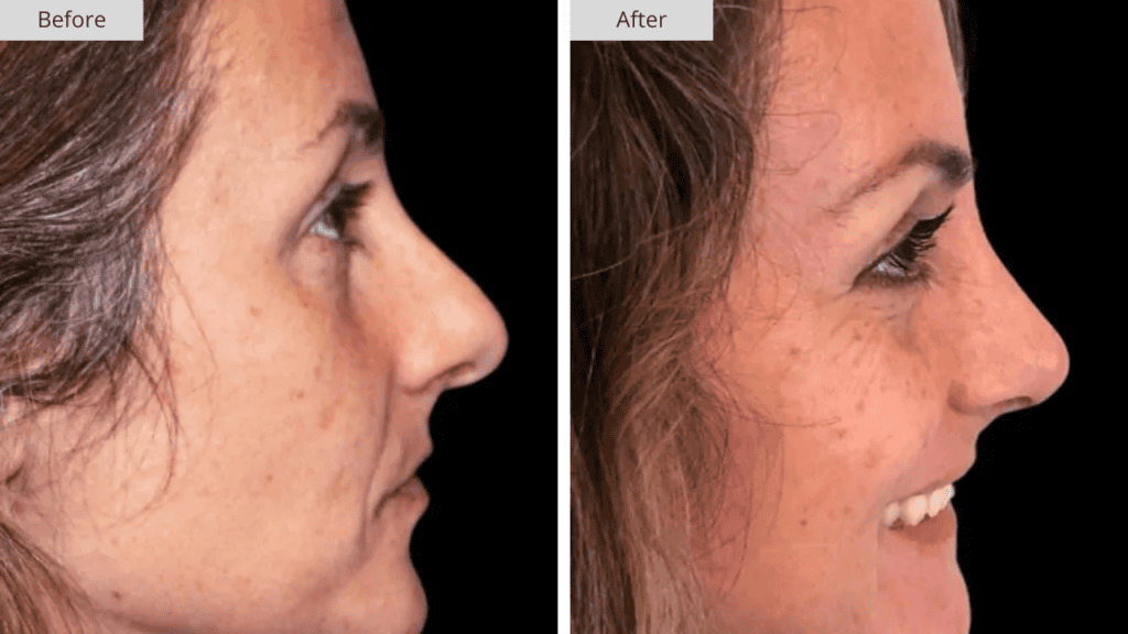 Rinoplastia Paciente 3