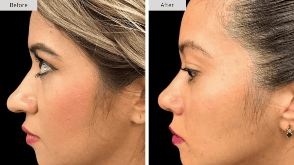 Rinoplastia Paciente 4