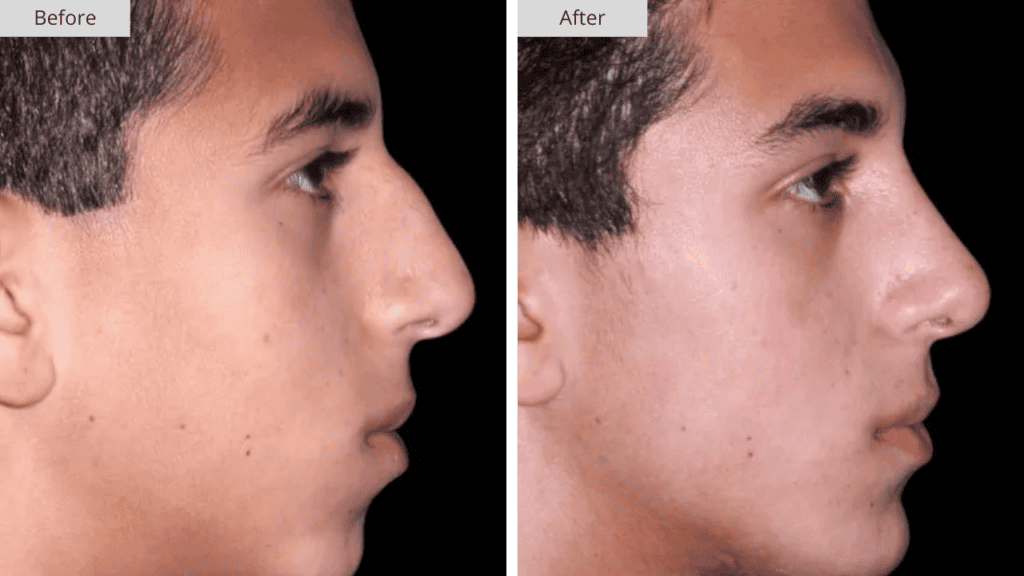 Rinoplastia Paciente 6