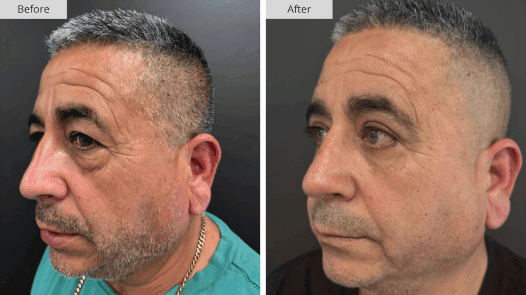 Blefaroplastia Paciente 2