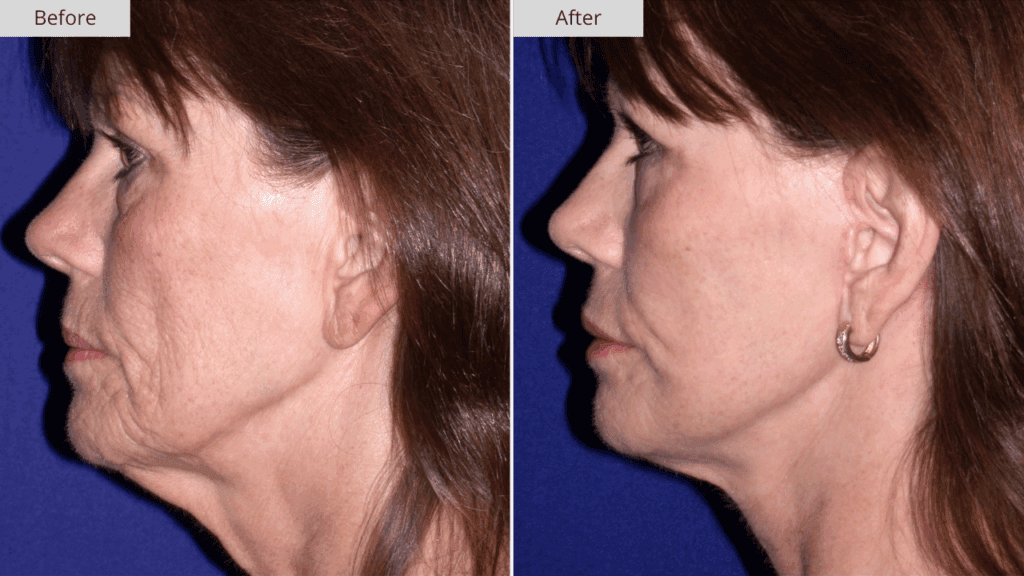 Estiramiento Facial Paciente 1