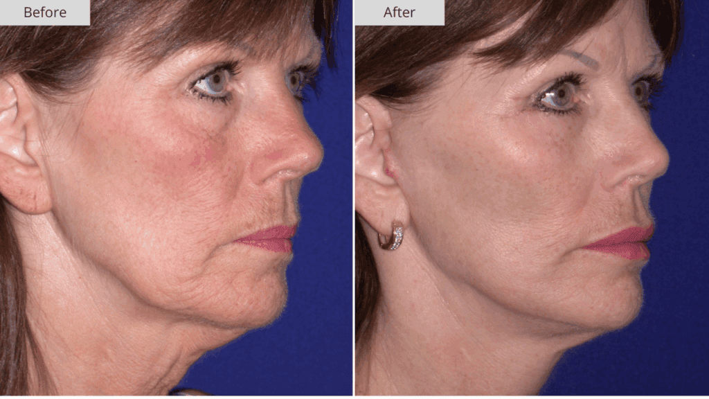 Estiramiento Facial Paciente 2