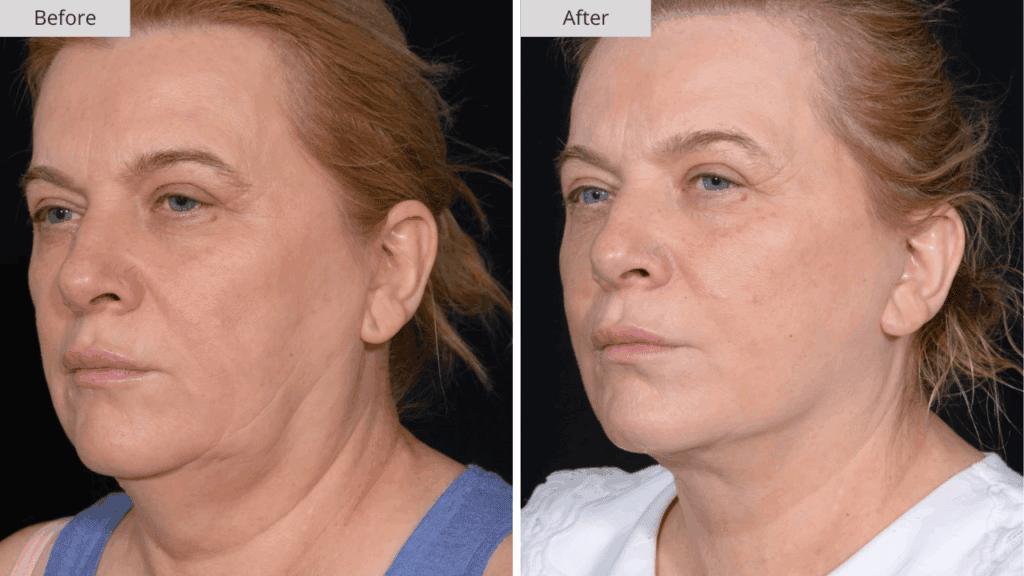 Estiramiento Facial Paciente 3