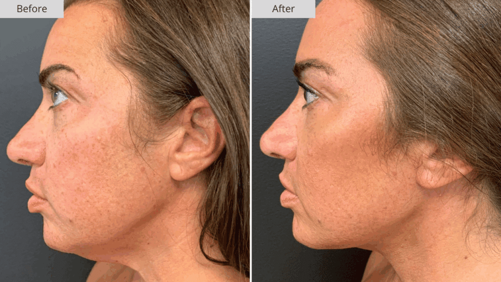 Estiramiento Facial Paciente 4