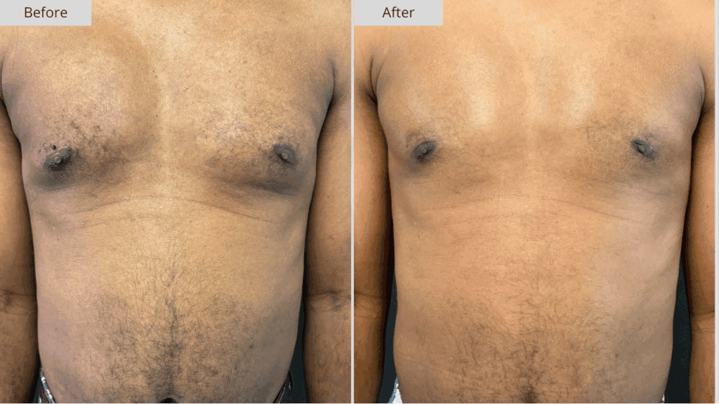 Ginecomastia Paciente 1