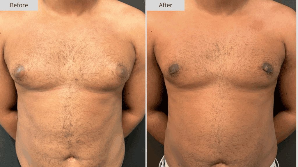 Ginecomastia Paciente 2