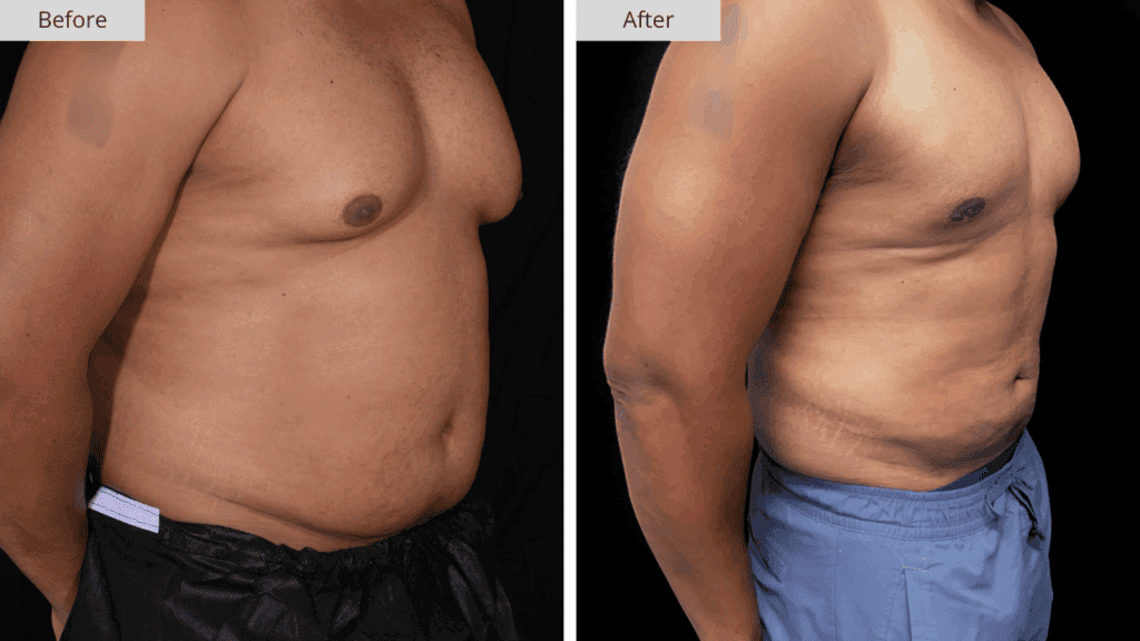 Ginecomastia Paciente 3