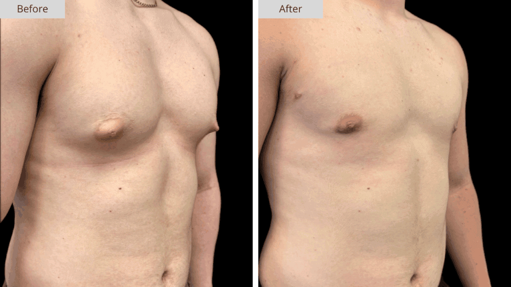 Ginecomastia Paciente 4